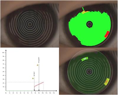 Application of orthokeratology on myopia control and its effect on ocular surface and meibomian gland function in Chinese myopic adolescents